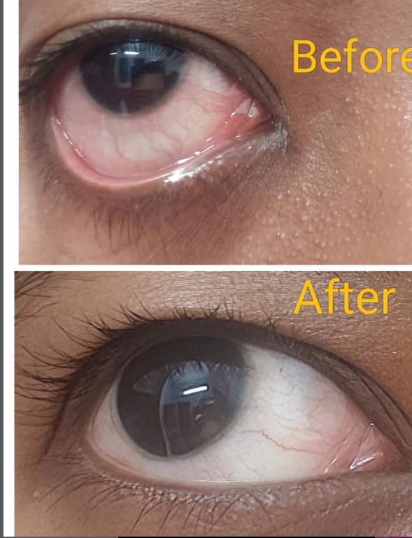 Before and After - Eye Condition Treatment